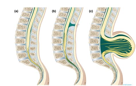 bofuda|Spina bifida